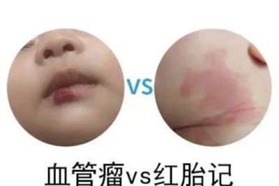 宝宝红色胎记是血管瘤吗？